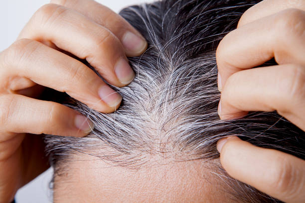 White Hair and Natural Ways to Prevent It